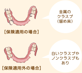 部分入れ歯