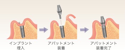 インプラント埋入手術