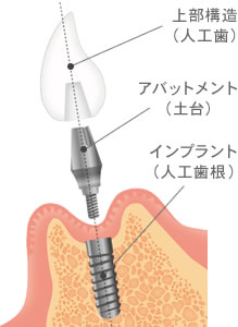 オーダーメイドの入れ歯